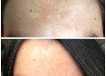 Consumidora 2: melasma na região da testa